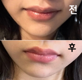 3주만에 다시 맞았어요 이번이 두 번째인데 확실히 효과가 나오는 거 같아요!!