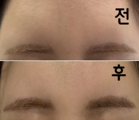 눈썹은 2번 정도면 사라지는 경우가 많다고 해서 다시 한국에 방문하려고 합니다!