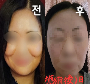 포키주사 놓는데 있어서 '여기는 피하는 게 좋다' 고 궁금한 점을 바로 발견해 주셨습니다!