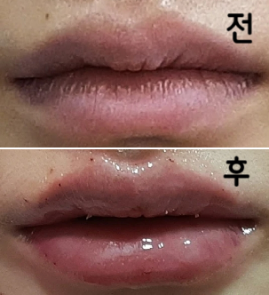 입꼬리 보톡스도 같이 맞았는데 입술필러 맞고 나니까 하관 여백이 줄어들어서 좋고, 원래 오버립을 하는 편인데 오버립 할 때도 편해서 좋아요!!