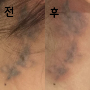 레이저 6번 받았는데 많이 지워졌어요~