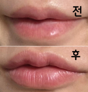 입술필러 시술 무조건 추천합니다! 입고리 보톡스 함께 진행했는데 만족도 너무 높습니다!!