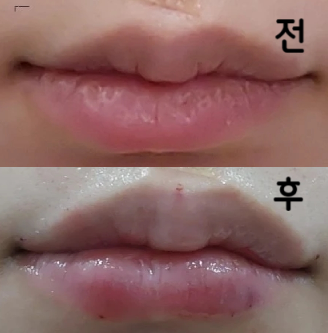 이번에도 입술필러 조금 더 해주셨는데 굉장히 이상형대로여서 만족합니다!