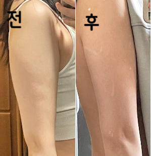 팔둑의 변화는 별로 없었지만 주물렀을 때 부드러워진 것 같아요!