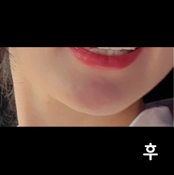 너무 자세하고 자상하게 봐주셔서 맘이 놓였고, 경과도 좋아요~!!