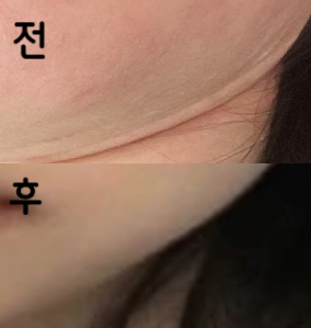 스테로이드로 맞아봤는데 효과 있었습니다!!