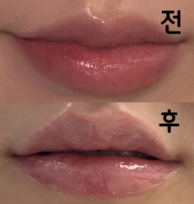 성형외과에서 이렇게 환자한테 친절한 곳이 있었나 생각했어요 결과물도 너무 맘에 들구 리터치도 있대서 방문할 생각입니다~~~