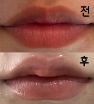 생각대로 마무리가 돼서 대만족이었고 무엇보다 통증이 적어서 놀랐습니다~ 다음에 또 올게요~