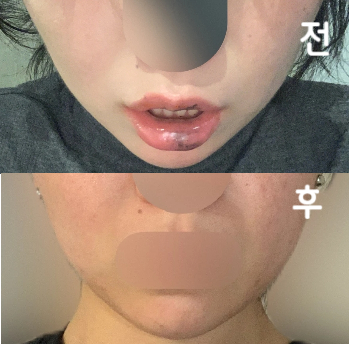 안 맞은 것보다는 진짜 맞는게 낫다는 걸 사진 보며 느낍니다! 얼굴 군살이 정리돼요~