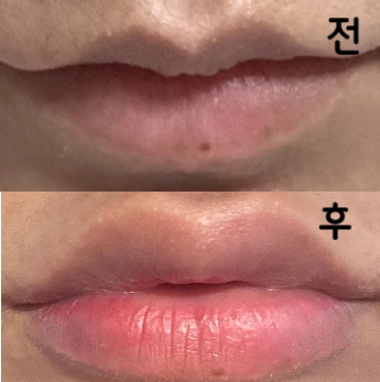 안 해본 사람은 있어도 한 번 하면 꾸준히 받는다는 입술필러,, 진짜 신세계입니다! 인스타 스타 입술 가능!