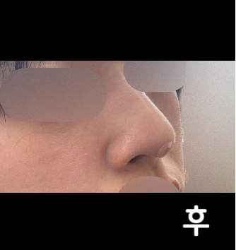 필러 가격 포함되어 있어서 좋아요! 시술 중에도 계속 체크하면서 더 하면 과해질 거 같다고 해주셔서 좋았어용~