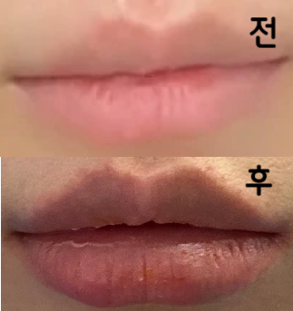 입술필러 처음이라 몇 개월동안 고민하다가 맞은건데 걱정과는 달리 모양이나 볼룸감 둘 다 너무 맘에 들어요ㅠㅠ 강추합니다!!!