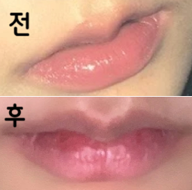 원장님 목소리도 나긋나긋하시고 친절하셔서 맞을 때 편안했어요! 잘 녹은 것 같네요~