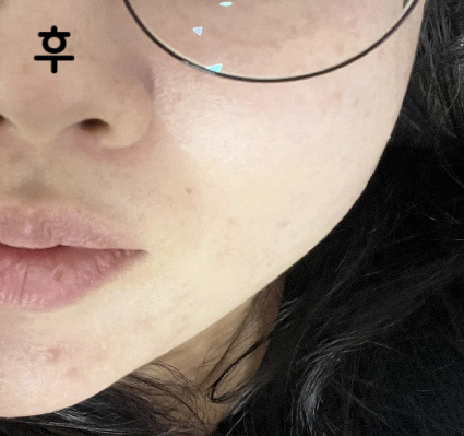 멍이 살짝 들었지만 시술 받을 때 긴장하지 않게 도움 주셔서 좋았어요!!!!