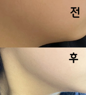 붓기 4시간이면 다 빠지구 벌써부터 효과 있는 거 같아서 기대중이에요!