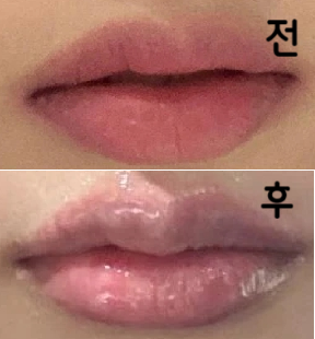 제가 원했던 가로 확장이랑 듀 입술 안되게... 자연스럽게 잘 된 것 같아요!! 롤리팝 입술필러 강추해요!!!