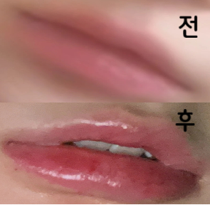 의사 선생님 너무 친절하세요~ 시술 중간중간 원하는 부위 물어봐주시고 꼼꼼하게 필러 놔주십니다~~