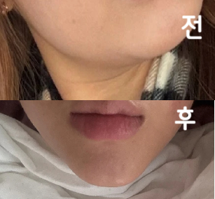 처음엔 효과가 없다고 생각했는데 보면 볼수록 좀 정리 된 거 같긴 해요! 한 번 더 맞아보려구요~