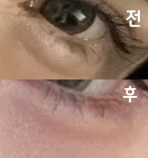 애교필러 녹이러 갔는데 실장님께서 설명 자세히 해주시고 추가 권유 없으셨어요~