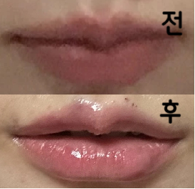 여러 곳에서 입술필러 맞아봤지만 여기가 제일 좋았어요!!