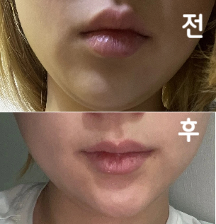 윤곽주사는 이 병원만 가요~ 가격도 괜찮고 병원도 괜찮고 효과도 짱좋^^