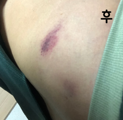 저는 포키주사 효과 꽤 본 편이에요!! 멍은 들 수 있습니다~