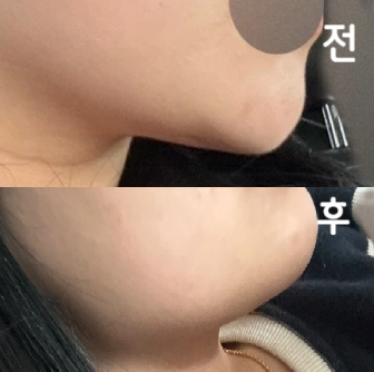 주차도 편했고 통증도 별로 없었고 대기가 좀 길었지만 효과는 좋은 거 같아용 2회차 또 받으러 가려구용~
