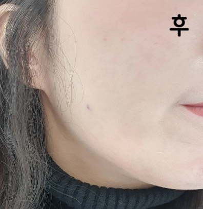 아프지 않게 주사를 잘 놓아주셨고 붓기는 직후에는 심했지만 3시간이내로 없어졌어요 경과 지켜보도록 할게요!