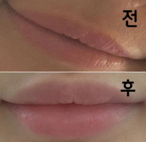 여태 맞아본 입술필러 중 가장 맘에 들어요! 친절하시구 원하는대로 잘 해주십니다!! 안 아파요!!!