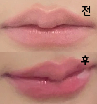 분위기도 좋고 친절하셨어요 시술 받는 중간 중간에 확인할 수 있어서 좋았습니당~