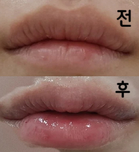 필요 없는 시술은 상담 시 생략해주시고 예산 내에서 여러가지 제안 해주셨어요~!