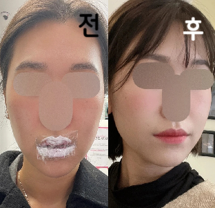 턱쪽에 살이 진짜 많았는데 살 잡히는게 확연히 줄었음!
