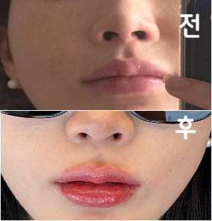쥬베룩,, 넘 아프지만 모공에 효과가 좋아서 멈출 수 없어요...