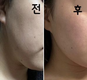 시술한지 4일 쯤 지났나? 주변에서 요즘 생김새 좋다, 살 빠졌다 등 이런 말 슬슬 듣기 시작했어요!