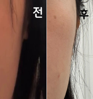 땅콩형 얼굴 개선에 넘 좋아용~ 처음이라 조금 넣었는데도 만족합니당~