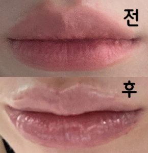 처음 입술필러 맞았는데 너무 이쁘게 실장님께서 자세히 설명해주시고 너무 좋았어용~ 리터치 하러 또 갈려구욤~