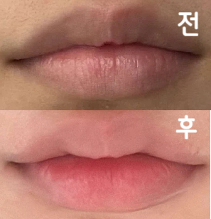 아픈거 너무너무 시러해서 떨었는데 1도 안 아팠구 너무너무 예뻐여!!