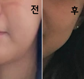 제가 지금까지 맞았던 주사들 중에선 젤 효과 좋은 것 같아요~!