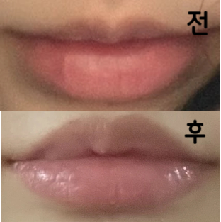 다들 너무 친절하셔서 좋았고 원하는 입술 모양 계속 물어봐주시면서 시술해주셔서 좋았습니다!