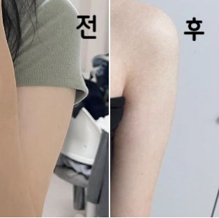팔뚝살 고민 때문에 갔는데 등까지 추천해주셔서 같이 맞았는데 효과 너무 좋아용!!