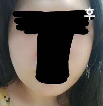 얼굴이 팽팽해진게 느껴지고 윤곽라인도 슬슬 정리 되고 있어서 만족합니다 ㅎㅎ