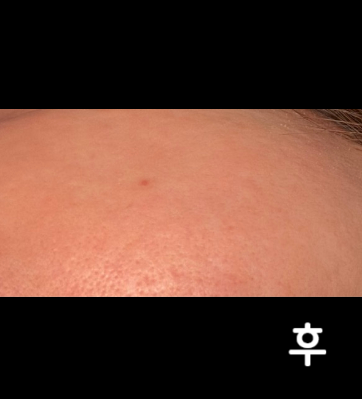 리프팅 목적이라 간단히 좋아여! 아프지도 않아여~