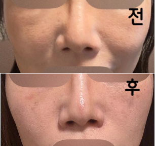 주입 직후부터 필러가 녹아 불독과 같았던 볼이 없어져 1주일이 지난 지금은 완전히 없어졌습니다!!