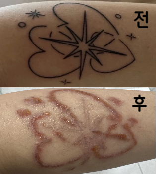 점차 지워지고 있는게 육안으로 보여서 너무 좋아요~