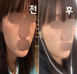 직원분들과 원장님이 친절하십니다! 붓기도 다음 날 되면 거의 가라앉아요!