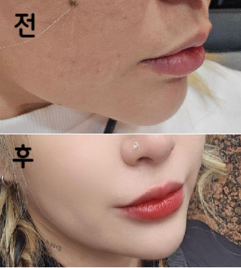 하루만에 효과가 보여요! 꾸준히 맞을 계획입니다!!