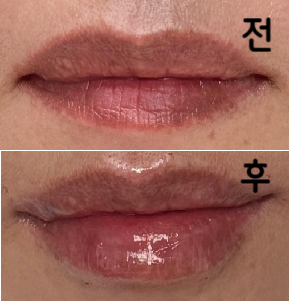 딸이 입술라인도 너무 예뻐지고 볼륨감도 살아나서 훨씬 세련되어 보인대요~