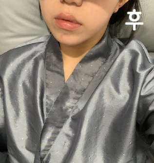 3회차 결제해서 지금 2회차까지 맞았는데 진짜 복부 살이 많이 줄어들었어요! 진짜 만족스러운 시술이라 다른 부위도 맞을까 생각 중이에요 ㅎㅎ