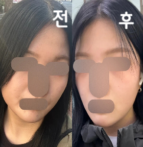 2주 경과 후 재방문해서 시술 받았는데 역시 효과 좋고 2번 맞으니까 더 효과 큰 것 같아요~