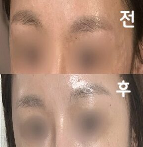 두통이 있어 맞게 됐어요. 포인트 잘 잡아주셔서 맞을 때마다 시원했다능..